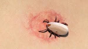 Lyme Disease – Causes, Symptoms and Treatment Methods